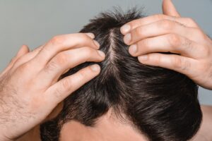 Closeup,Male,Dark,Hair.,Head,Skin,Problems,,Receding,Hairline,,Alopecia,