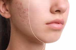Close-up of a teenage girl’s skin before and after Opus Skin Rejuvenation treatment, showcasing noticeable improvement in acne scars against a white background